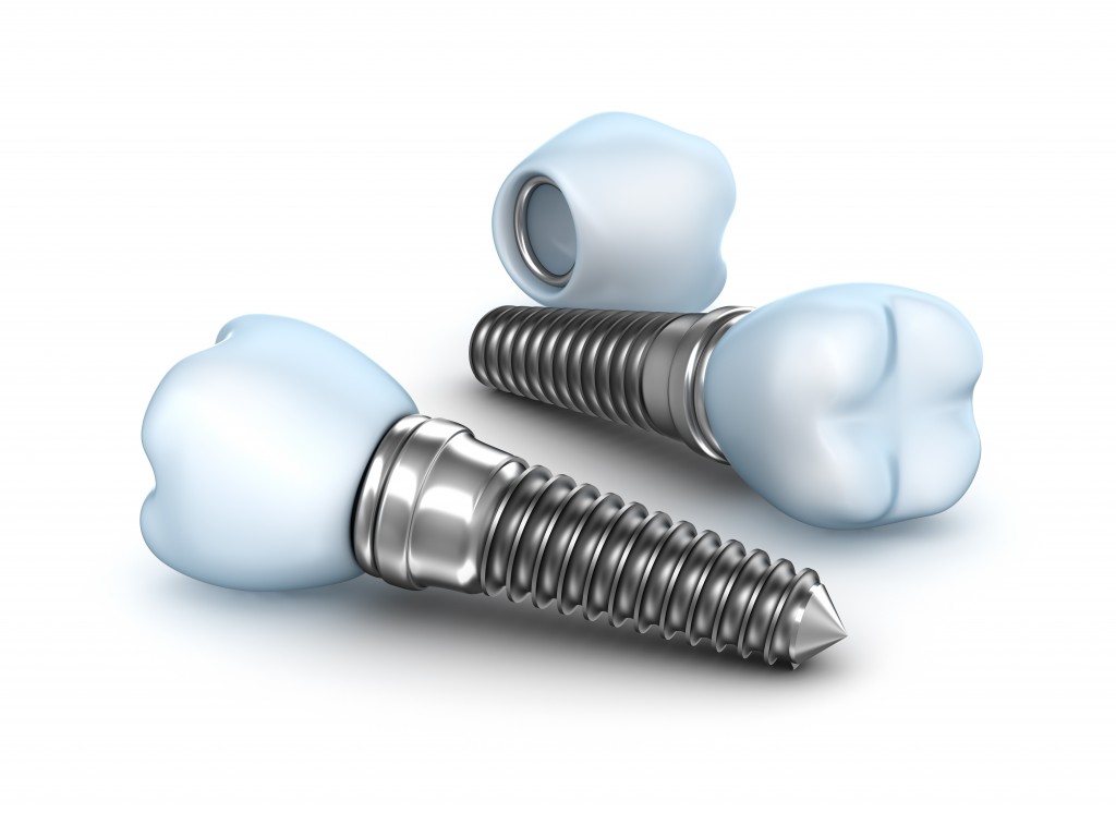 A graphic of several dental implants